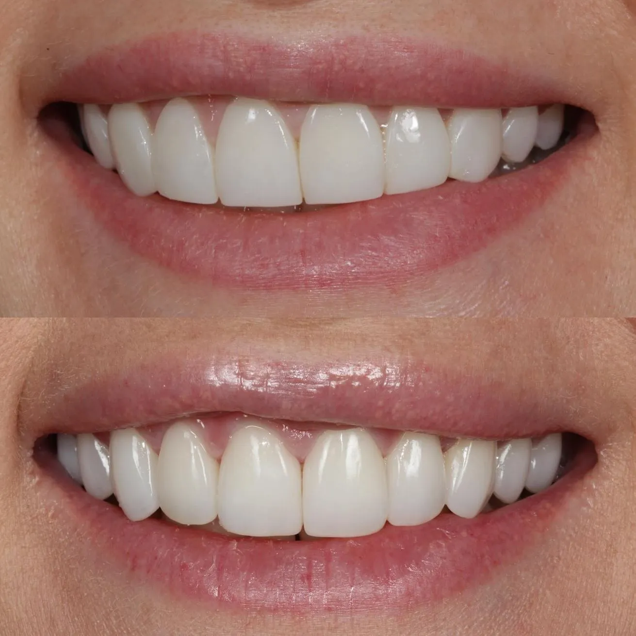 Strong Demand for Teeth Whitening