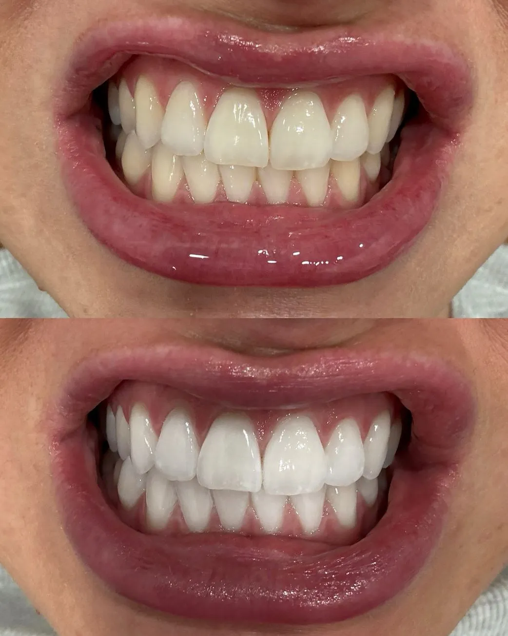 teeth whitening course